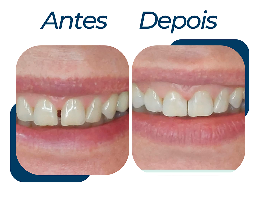 ANTES-DPS-3.png