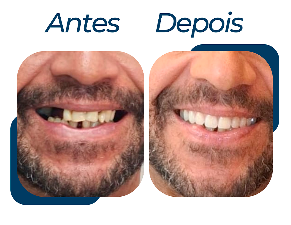 ANTES-DPS-4.png